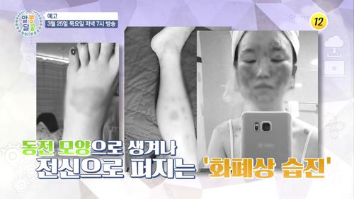 환절기 피부에 찾아오는 '이 질환'을 조심하라!_알콩달콩 74회 예고 TV CHOSUN 210325 방송