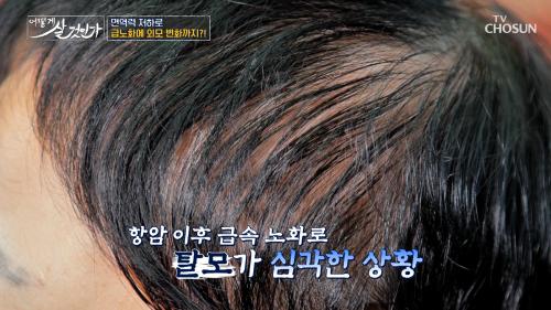 50대에 청천벽력 같은 암 진단  항암과 함께 찾아온 탈모와 급속 노화  TV CHOSUN 250309 방송