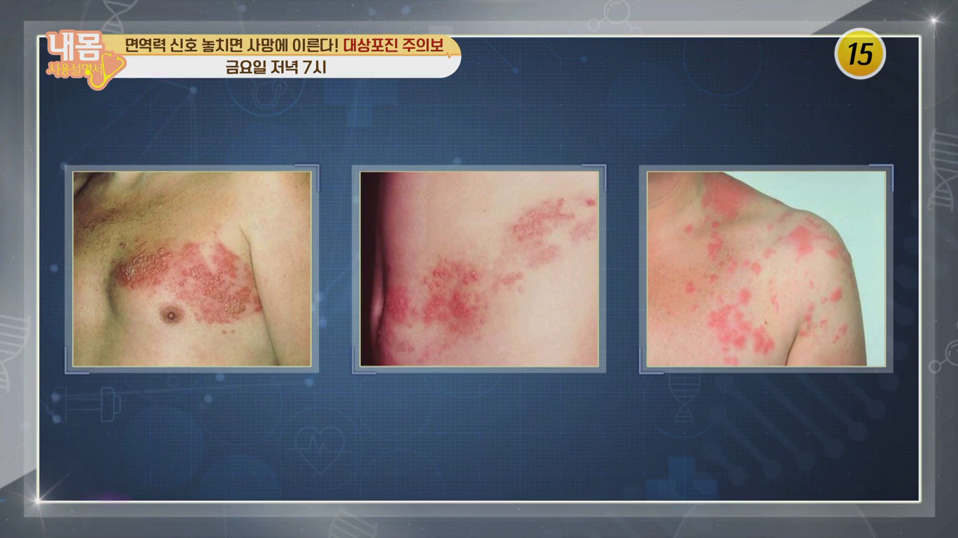 면역력 잡아 대상포진에서 벗어날 비법 대공개!_내 몸 사용 설명서 334회 예고 이미지